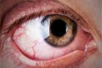 Glaucoma FOTO: WEB Glaucoma FOTO: WEB