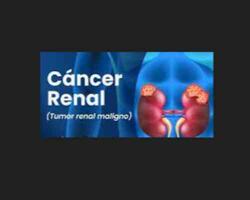 Cáncer renal FOTO: web