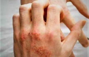 Dermatitis atópica  FOTO: WEB