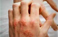 Dermatitis atópica  FOTO: WEB