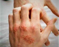 Dermatitis atópica  FOTO: WEB