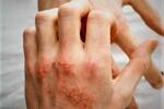 Dermatitis atópica  FOTO: WEB