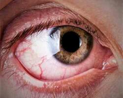 Glaucoma FOTO: WEB