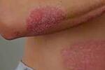 Psoriasis FOTO: WEB Psoriasis FOTO: WEB