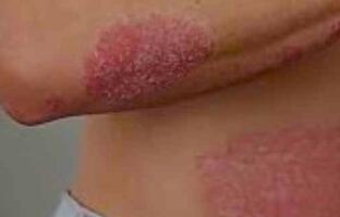 Psoriasis FOTO: WEB