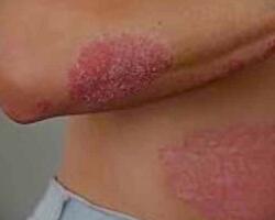 Psoriasis FOTO: WEB